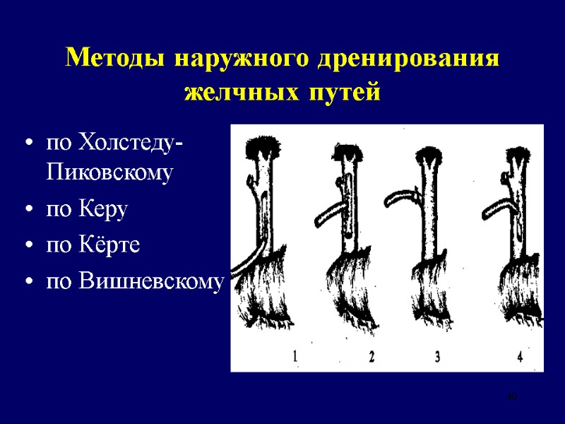 40 Методы наружного дренирования желчных путей по Холстеду-Пиковскому по Керу по Кёрте по Вишневскому